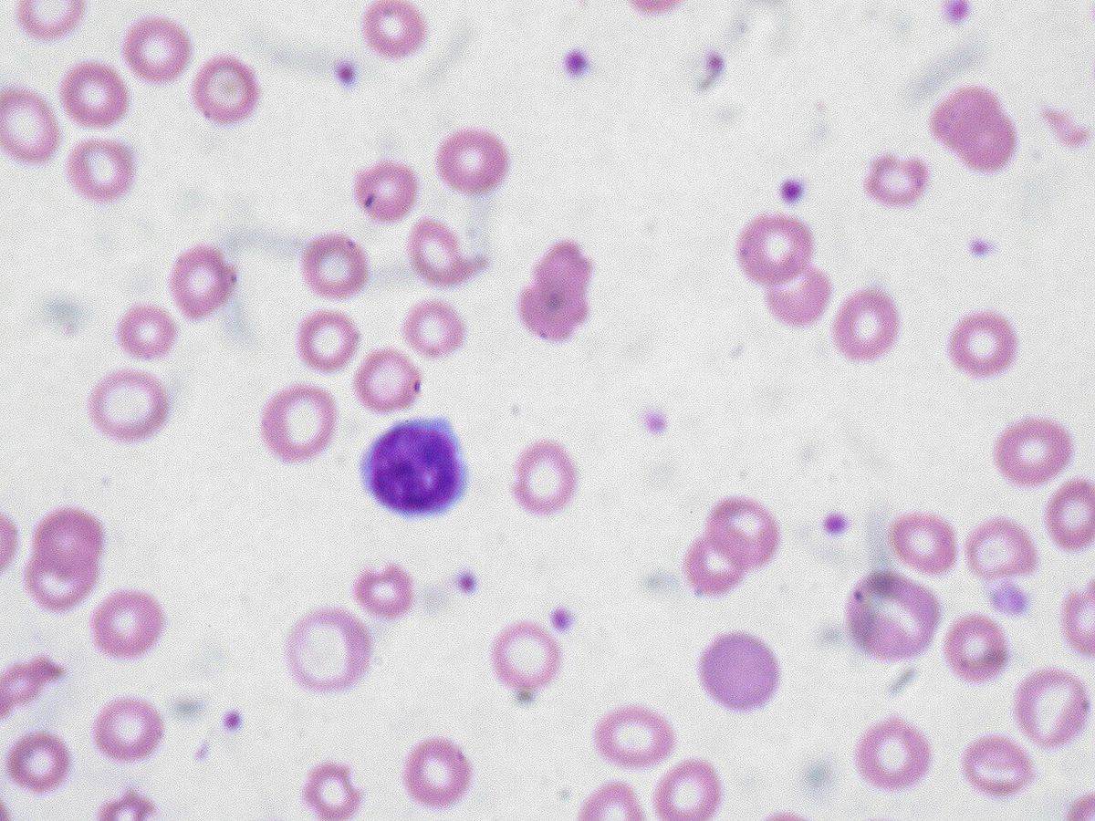Anemia: Kenali Gejala Kurang Darah dan Makanan Penambah Darah