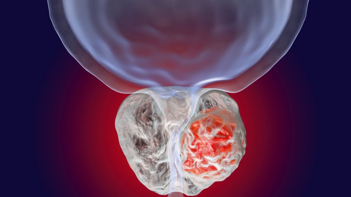 Prostate Cancer: Recognize the Symptoms in Men Early