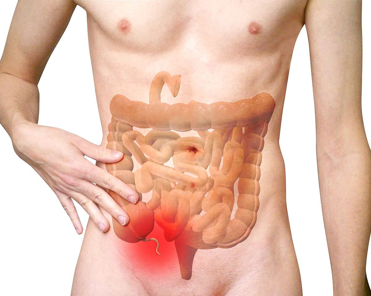 Appendicitis: Symptoms You Must Not Ignore