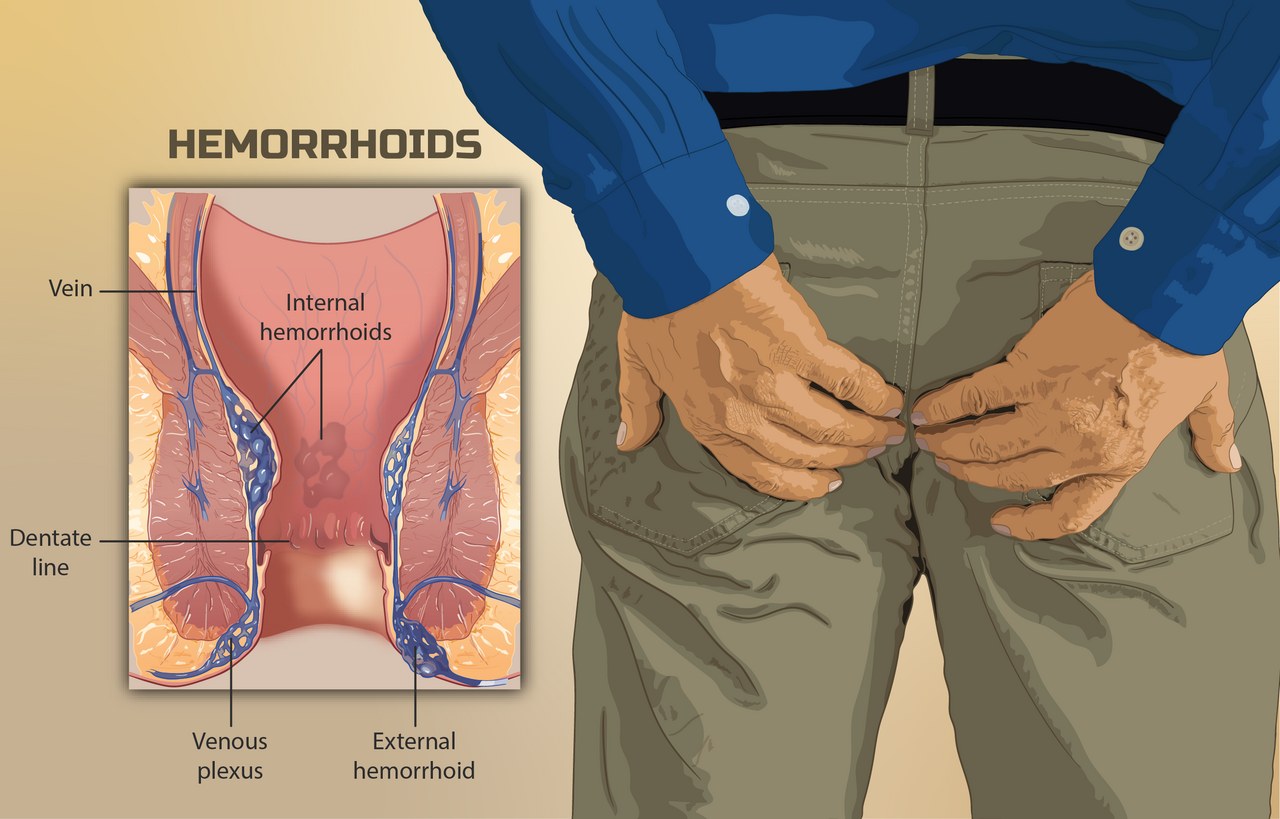 Hemorroides (Wasir): Conoce los síntomas y cómo tratarlas